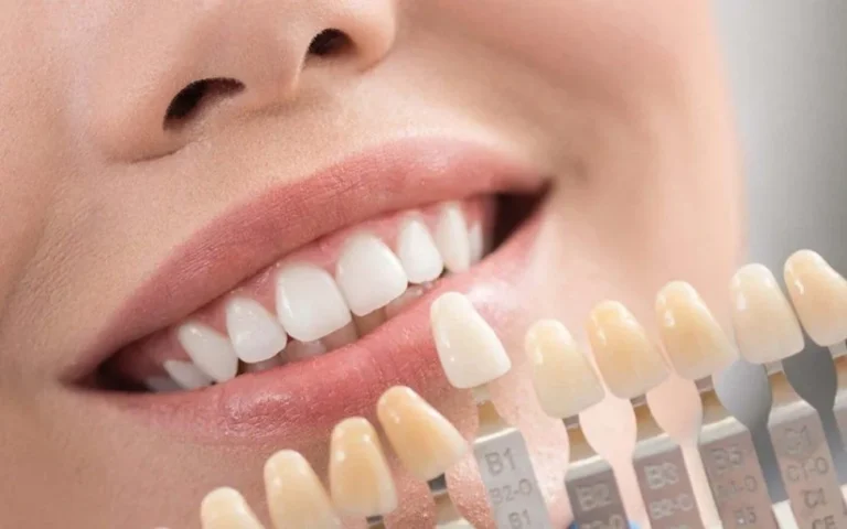Laminate Veneers